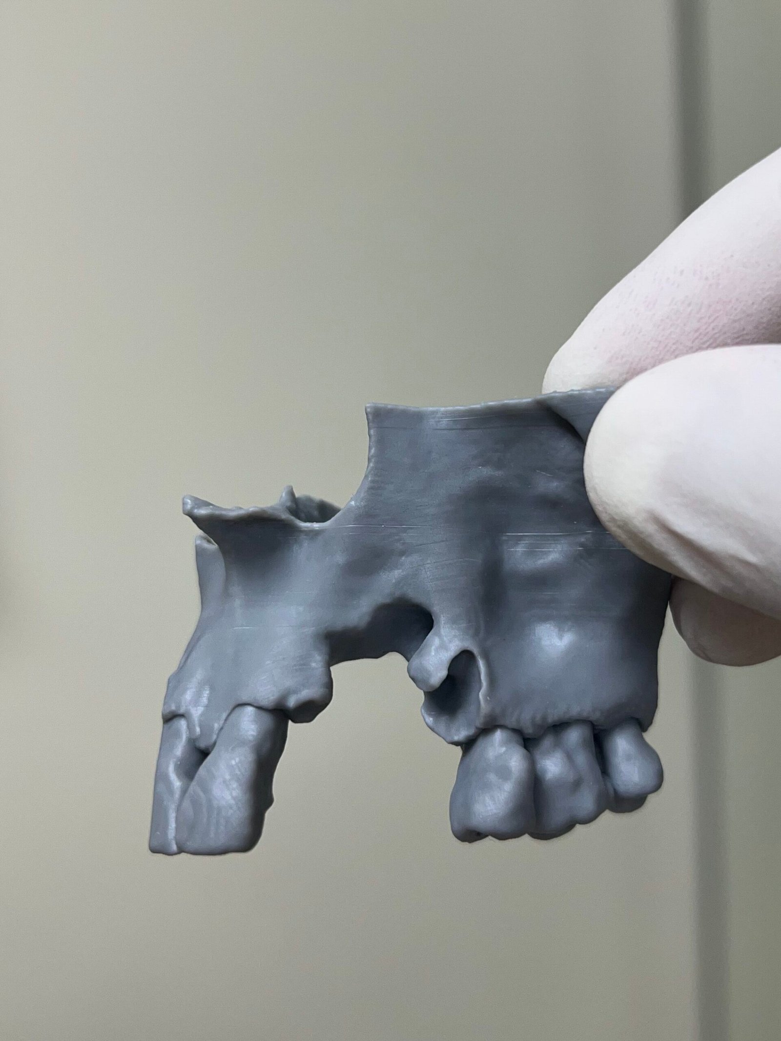 Implante Dentário